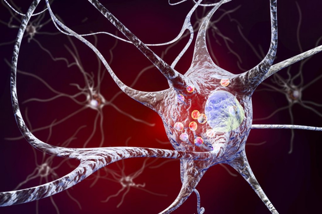 Parkinson kórral ferőzött neuronok