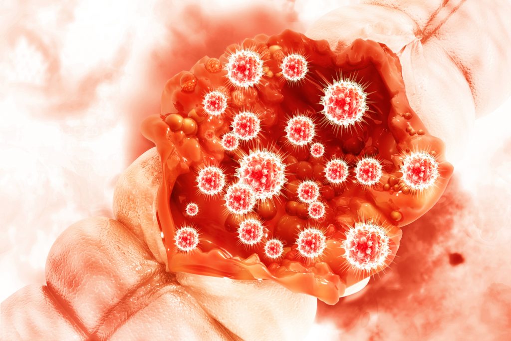 humán papillomavírus fertőzés pozitív